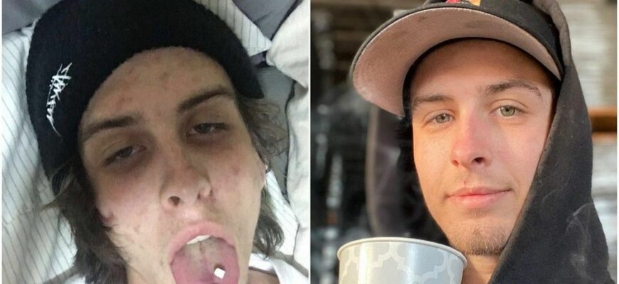 До и после: 40 фото людей, которые решили завязать с наркотиками