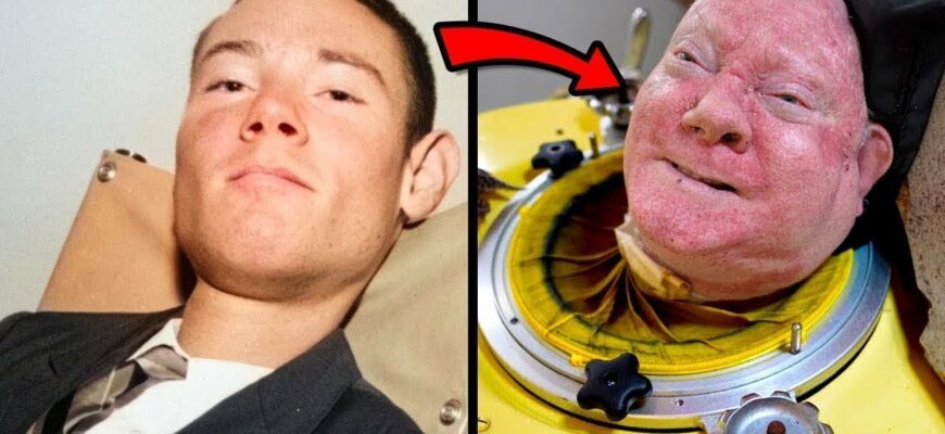 Умер последний человек с «железными лёгкими» (5 видео)